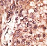 OASIS / CREB3L1 Antibody - Formalin-fixed and paraffin-embedded human cancer tissue reacted with the primary antibody, which was peroxidase-conjugated to the secondary antibody, followed by DAB staining. This data demonstrates the use of this antibody for immunohistochemistry; clinical relevance has not been evaluated. BC = breast carcinoma; HC = hepatocarcinoma.