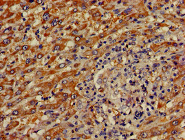 OASIS / CREB3L1 Antibody - Immunohistochemistry of paraffin-embedded human liver cancer using CREB3L1 Antibody at dilution of 1:100