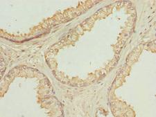 OAZ1 / OAZ Antibody - Immunohistochemistry of paraffin-embedded human prostate cancer at dilution 1:100