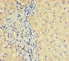 OBP2A Antibody - Immunohistochemistry of paraffin-embedded human liver cancer using OBP2A Antibody at dilution of 1:100