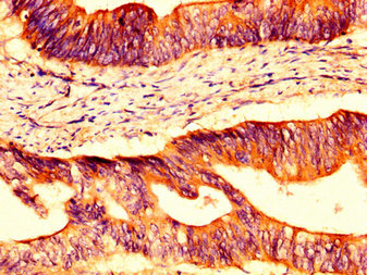 OCLN / Occludin Antibody - Immunohistochemistry image at a dilution of 1:400 and staining in paraffin-embedded human colon cancer performed on a Leica BondTM system. After dewaxing and hydration, antigen retrieval was mediated by high pressure in a citrate buffer (pH 6.0) . Section was blocked with 10% normal goat serum 30min at RT. Then primary antibody (1% BSA) was incubated at 4 °C overnight. The primary is detected by a biotinylated secondary antibody and visualized using an HRP conjugated SP system.
