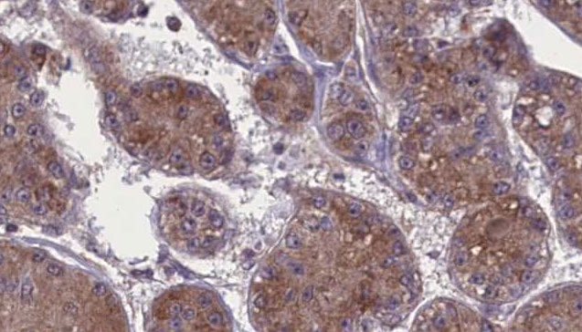 OCLN / Occludin Antibody - 1:100 staining human liver carcinoma tissues by IHC-P. The sample was formaldehyde fixed and a heat mediated antigen retrieval step in citrate buffer was performed. The sample was then blocked and incubated with the antibody for 1.5 hours at 22°C. An HRP conjugated goat anti-rabbit antibody was used as the secondary.