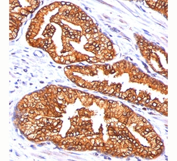 ODC1 / Ornithine Decarboxylase Antibody - ODC-1 antibody ODC1/485 immunohistochemistry prostate carcinoma.  This image was taken for the unmodified form of this product. Other forms have not been tested.