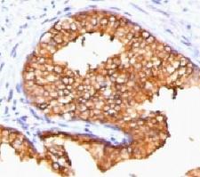 ODC1 / Ornithine Decarboxylase Antibody - IHC testing of FFPE human prostate carcinoma and ODC antibody (ORN255-1).  This image was taken for the unmodified form of this product. Other forms have not been tested.