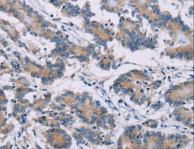 ODF2 Antibody - Immunohistochemistry of paraffin-embedded Human colon cancer using ODF2 Polyclonal Antibody at dilution of 1:30.