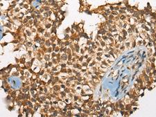 ODF2 Antibody - Immunohistochemistry of paraffin-embedded Human ovarian cancer tissue  using ODF2 Polyclonal Antibody at dilution of 1:110(×200)