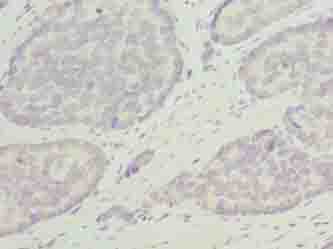 ODF3L1 Antibody - Immunohistochemistry of paraffin-embedded human gastric cancer using antibody at dilution of 1:100.