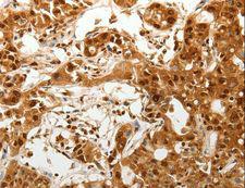 ODZ3 Antibody - Immunohistochemistry of paraffin-embedded Human lung cancer using TENM3 Polyclonal Antibody at dilution of 1:50.