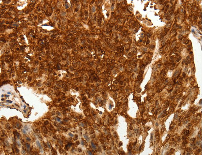 ODZ3 Antibody - Immunohistochemistry of paraffin-embedded Human lung cancer using TENM3 Polyclonal Antibody at dilution of 1:50.