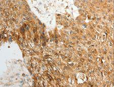 ODZ3 Antibody - Immunohistochemistry of paraffin-embedded Human ovarian cancer using TENM3 Polyclonal Antibody at dilution of 1:50.