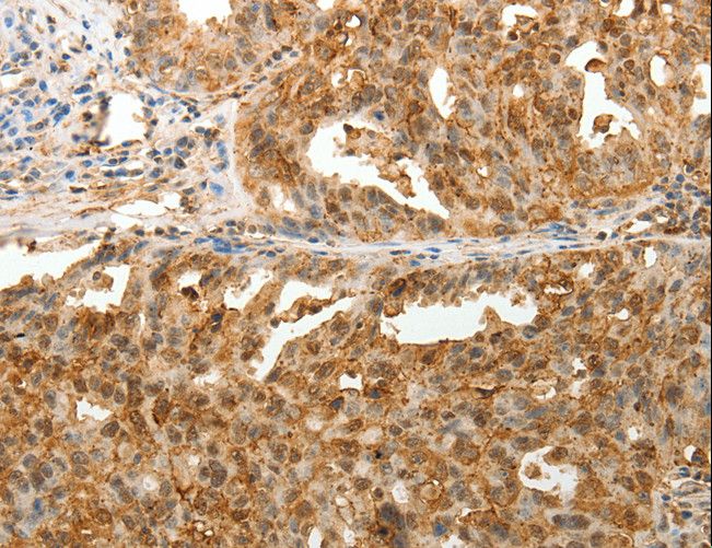 ODZ3 Antibody - Immunohistochemistry of paraffin-embedded Human ovarian cancer using TENM3 Polyclonal Antibody at dilution of 1:50.