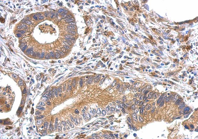 OFD1 Antibody - OFD1 antibody detects OFD1 protein at cytosol on gastric carcinoma by immunohistochemical analysis. Sample: Paraffin-embedded gastric carcinoma. OFD1 antibody dilution:1:500.