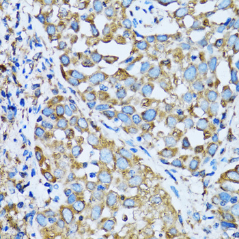 OGDH Antibody - Immunohistochemistry of paraffin-embedded human lung cancer tissue.