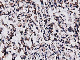 OGFOD1 Antibody - IHC of paraffin-embedded Adenocarcinoma of Human colon tissue using anti-OGFOD1 mouse monoclonal antibody. (Heat-induced epitope retrieval by 10mM citric buffer, pH6.0, 100C for 10min).