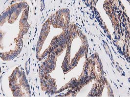 OGFOD1 Antibody - IHC of paraffin-embedded Carcinoma of Human prostate tissue using anti-OGFOD1 mouse monoclonal antibody. (Heat-induced epitope retrieval by 10mM citric buffer, pH6.0, 100C for 10min).