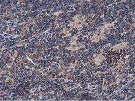 OGFOD1 Antibody - IHC of paraffin-embedded Human lymphoma tissue using anti-OGFOD1 mouse monoclonal antibody. (Heat-induced epitope retrieval by 10mM citric buffer, pH6.0, 100C for 10min).