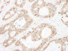 OGFR Antibody - Detection of human OGFR by immunohistochemistry. Sample: FFPE section of human ovarian carcinoma. Antibody: Affinity purified rabbit anti- OGFR used at a dilution of 1:1,000 (1µg/ml). Detection: DAB