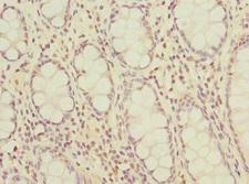 OGFR Antibody - Immunohistochemistry of paraffin-embedded human colon cancer at dilution 1:100