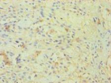 OGT / O-GLCNAC Antibody - Immunohistochemistry of paraffin-embedded human breast cancer using antibody at 1:100 dilution.  This image was taken for the unconjugated form of this product. Other forms have not been tested.