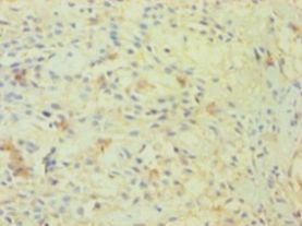 OGT / O-GLCNAC Antibody - Immunohistochemistry of paraffin-embedded human breast cancer using antibody at 1:100 dilution.  This image was taken for the unconjugated form of this product. Other forms have not been tested.
