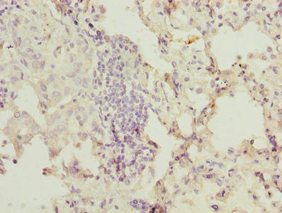 OGT / O-GLCNAC Antibody - Immunohistochemistry of paraffin-embedded human lung cancer using OGT Antibody at dilution of 1:100