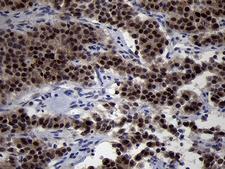 OIP5 Antibody - Immunohistochemical staining of paraffin-embedded Carcinoma of Human pancreas tissue using anti-OIP5 mouse monoclonal antibody. (Heat-induced epitope retrieval by 1mM EDTA in 10mM Tris buffer. (pH8.5) at 120°C for 3 min. (1:500)