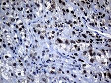OIP5 Antibody - Immunohistochemical staining of paraffin-embedded Carcinoma of Human kidney tissue using anti-OIP5 mouse monoclonal antibody. (Heat-induced epitope retrieval by 1mM EDTA in 10mM Tris buffer. (pH8.5) at 120°C for 3 min. (1:500)