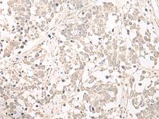 OLA1 Antibody - Immunohistochemistry of paraffin-embedded Human lung cancer tissue  using OLA1 Polyclonal Antibody at dilution of 1:55(×200)