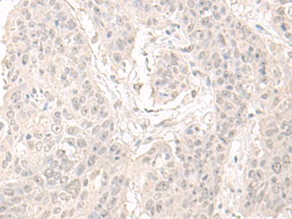 OLA1 Antibody - Immunohistochemistry of paraffin-embedded Human esophagus cancer tissue  using OLA1 Polyclonal Antibody at dilution of 1:55(×200)