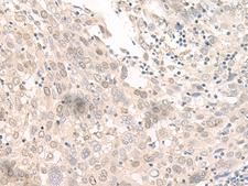 OLA1 Antibody - Immunohistochemistry of paraffin-embedded Human prost at e cancer tissue  using OLA1 Polyclonal Antibody at dilution of 1:45(×200)