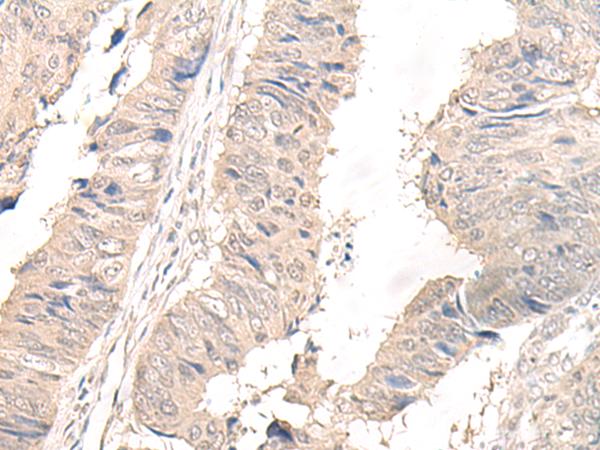 OLA1 Antibody - Immunohistochemistry of paraffin-embedded Human lung cancer tissue  using OLA1 Polyclonal Antibody at dilution of 1:45(×200)