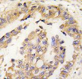 OLFM1 Antibody - Formalin-fixed and paraffin-embedded human lung carcinoma tissue reacted with Olfm1 Antibody , which was peroxidase-conjugated to the secondary antibody, followed by DAB staining. This data demonstrates the use of this antibody for immunohistochemistry; clinical relevance has not been evaluated.