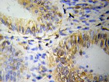 OLFM1 Antibody - Immunohistochemistry of paraffin-embedded human lung cancer using OLFM1 antibody.