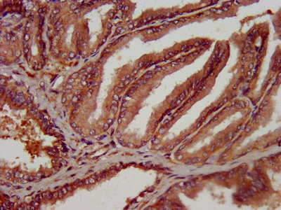 OLFM4 / Olfactomedin 4 Antibody - Immunohistochemistry image at a dilution of 1:300 and staining in paraffin-embedded human prostate tissue performed on a Leica BondTM system. After dewaxing and hydration, antigen retrieval was mediated by high pressure in a citrate buffer (pH 6.0) . Section was blocked with 10% normal goat serum 30min at RT. Then primary antibody (1% BSA) was incubated at 4 °C overnight. The primary is detected by a biotinylated secondary antibody and visualized using an HRP conjugated SP system.