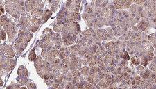 OMA1 Antibody - 1:100 staining human pancreas carcinoma tissue by IHC-P. The sample was formaldehyde fixed and a heat mediated antigen retrieval step in citrate buffer was performed. The sample was then blocked and incubated with the antibody for 1.5 hours at 22°C. An HRP conjugated goat anti-rabbit antibody was used as the secondary.