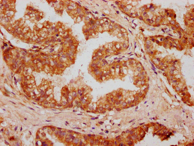 OMD / Osteomodulin Antibody - Immunohistochemistry Dilution at 1:400 and staining in paraffin-embedded human prostate cancer performed on a Leica BondTM system. After dewaxing and hydration, antigen retrieval was mediated by high pressure in a citrate buffer (pH 6.0). Section was blocked with 10% normal Goat serum 30min at RT. Then primary antibody (1% BSA) was incubated at 4°C overnight. The primary is detected by a biotinylated Secondary antibody and visualized using an HRP conjugated SP system.
