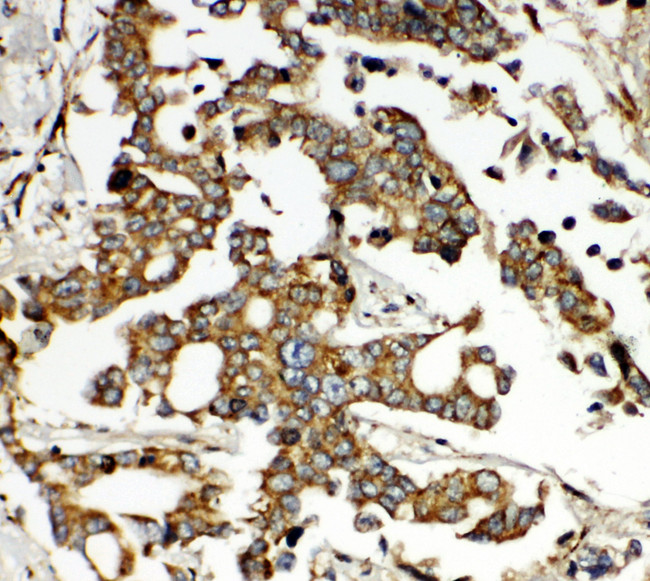 ONECUT1 / HNF6 Antibody - ONECUT1 / HNF6 antibody. IHC(P): Human Liver Cancer Tissue.