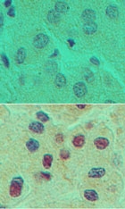 ONECUT1 / HNF6 Antibody - IHC of HNF6 in formalin-fixed, paraffin-embedded human liver tissue using an isotype control (top) and Peptide-affinity Purified Polyclonal Antibody to HNF6 (bottom) at 5 ug/ml.