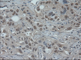 ONECUT1 / HNF6 Antibody - Immunohistochemical staining of paraffin-embedded Carcinoma of liver using anti-HNF6 mouse monoclonal antibody.