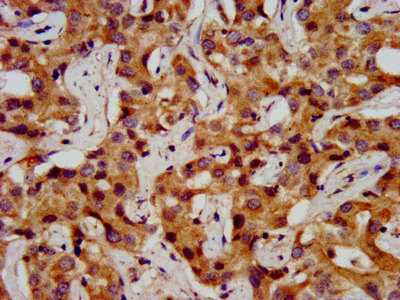 ONECUT1 / HNF6 Antibody - Immunohistochemistry image at a dilution of 1:200 and staining in paraffin-embedded human liver cancer performed on a Leica BondTM system. After dewaxing and hydration, antigen retrieval was mediated by high pressure in a citrate buffer (pH 6.0) . Section was blocked with 10% normal goat serum 30min at RT. Then primary antibody (1% BSA) was incubated at 4 °C overnight. The primary is detected by a biotinylated secondary antibody and visualized using an HRP conjugated SP system.