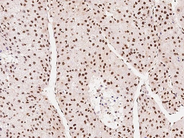 ONECUT1 / HNF6 Antibody - Immunochemical staining ONECUT1 in human hepatoma with rabbit polyclonal antibody at 1:1000 dilution, formalin-fixed paraffin embedded sections.