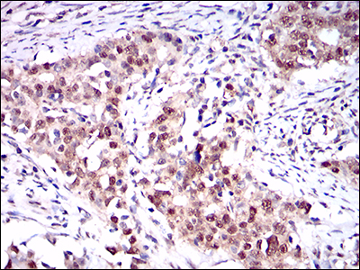 ONECUT3 / OC3 Antibody - IHC of paraffin-embedded cervical cancer tissues using ONECUT3 mouse monoclonal antibody with DAB staining.