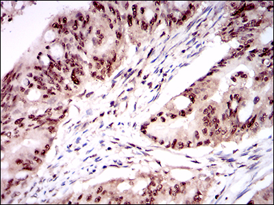 ONECUT3 / OC3 Antibody - IHC of paraffin-embedded rectum cancer tissues using ONECUT3 mouse monoclonal antibody with DAB staining.