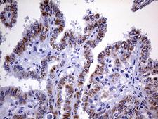 OPA3 Antibody - Immunohistochemical staining of paraffin-embedded Carcinoma of Human thyroid tissue using anti-OPA3 mouse monoclonal antibody. (Heat-induced epitope retrieval by 1mM EDTA in 10mM Tris buffer. (pH8.5) at 120°C for 3 min. (1:150)