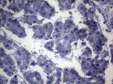 OPA3 Antibody - Immunohistochemical staining of paraffin-embedded Carcinoma of Human liver tissue using anti-OPA3 mouse monoclonal antibody. (Heat-induced epitope retrieval by 1mM EDTA in 10mM Tris buffer. (pH8.5) at 120°C for 3 min. (1:150)