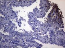 OPA3 Antibody - Immunohistochemical staining of paraffin-embedded Carcinoma of Human thyroid tissue using anti-OPA3 mouse monoclonal antibody. (Heat-induced epitope retrieval by 1mM EDTA in 10mM Tris buffer. (pH8.5) at 120°C for 3 min. (1:150)