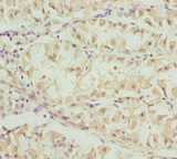 OPA3 Antibody - Immunohistochemistry of paraffin-embedded human gastric cancer at dilution 1:100