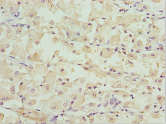 OPA3 Antibody - Immunohistochemistry of paraffin-embedded human gastric cancer at dilution 1:100