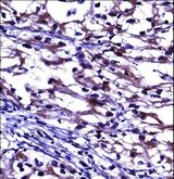 OPG / Osteoprotegerin Antibody - TNFRSF11B Antibody immunohistochemistry of formalin-fixed and paraffin-embedded human kidney carcinoma followed by peroxidase-conjugated secondary antibody and DAB staining.