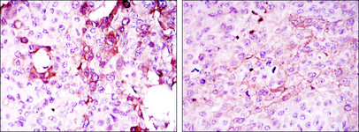 OPG / Osteoprotegerin Antibody - IHC of paraffin-embedded mammary cancer tissues (left) and lung cancer tissues (right) using TNFRSF11B mouse monoclonal antibody with DAB staining.